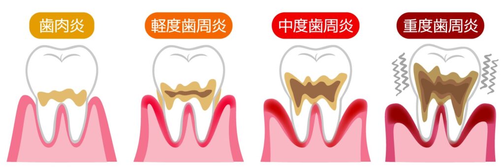 歯周病の進行段階イラスト