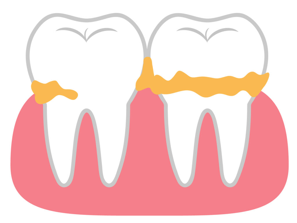 歯肉炎の原因となるプラークの付着