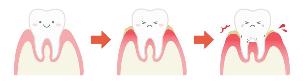 歯ぐきの健康状態と炎症の比較イラスト