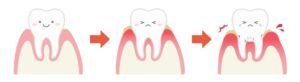 歯ぐきの健康状態と炎症の比較イラスト