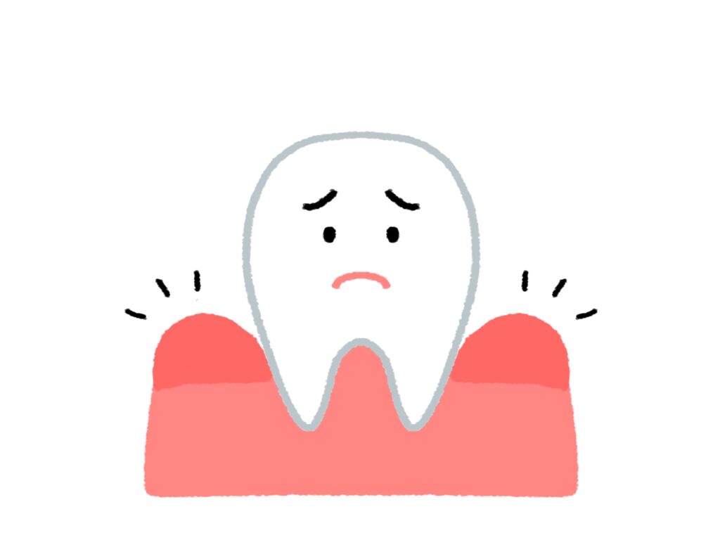 歯肉炎 赤く腫れた歯ぐき