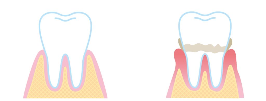 健康な歯肉と炎症を起こしている歯肉