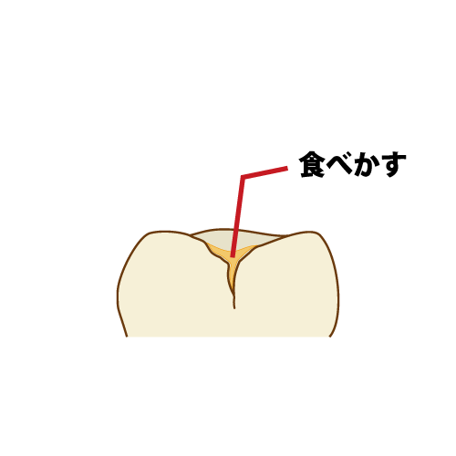 小窩裂溝に磨き残しが入っている図